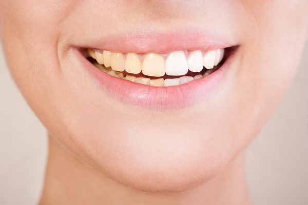 How Often Should You Do Professional In Office Teeth Whitening?