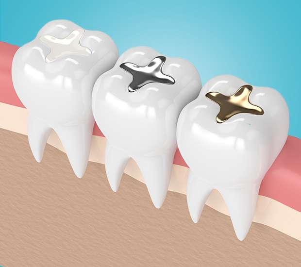 Hamilton Composite Fillings