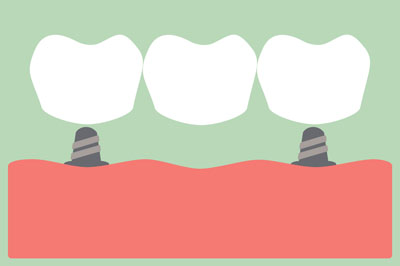 What Is A Dental Bridge And What Are They Used For?