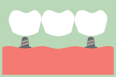 What Is A Dental Bridge And What Are They Used For?