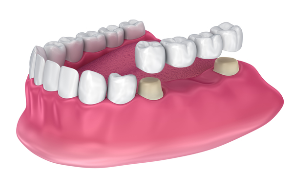 How Do Dental Bridges Work?