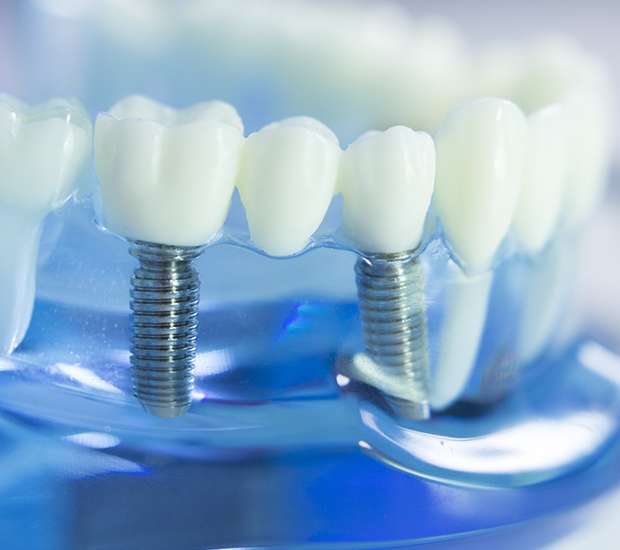 Hamilton Dental Implants