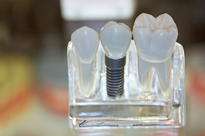 The Process Involved With Placing Dental Implants