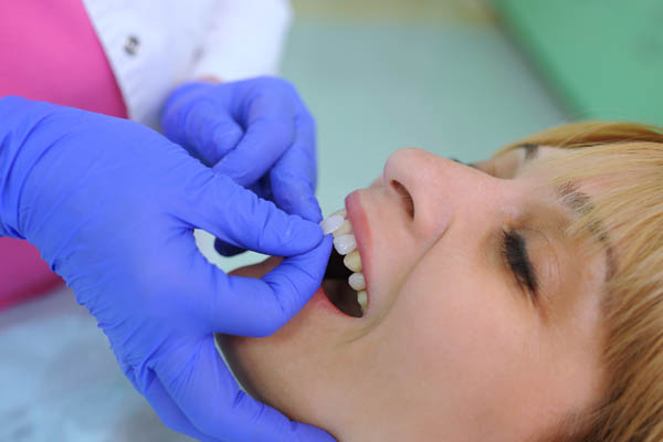 Learn About A New Smile Using Dental Veneers