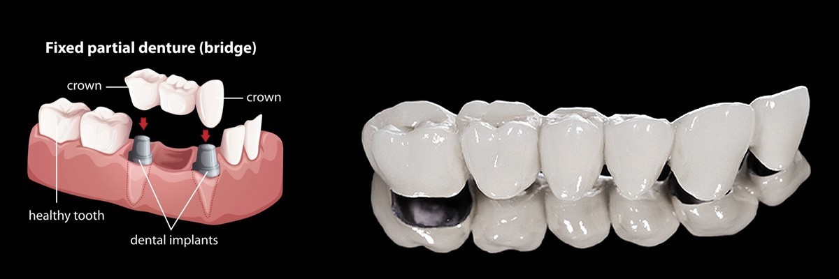 Hamilton Dentures