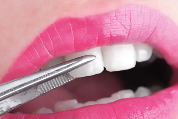 veneers Hamilton, OH