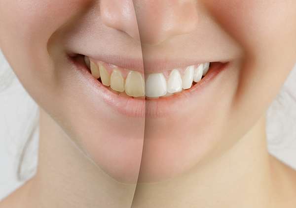 Learn About Professional Teeth Whitening Brands