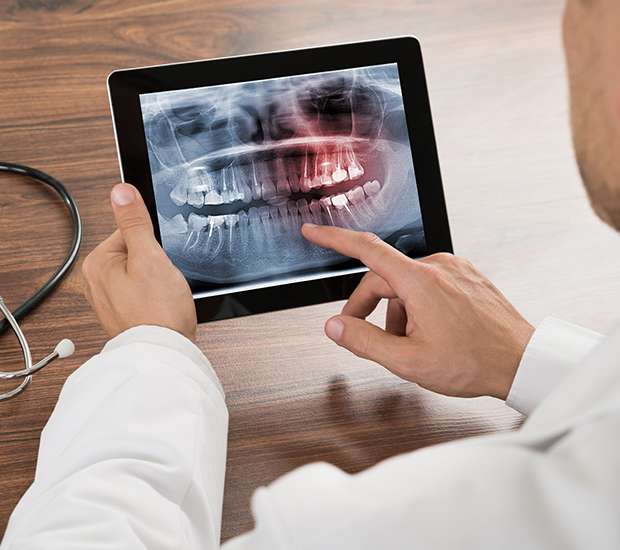 Hamilton Types of Dental Root Fractures