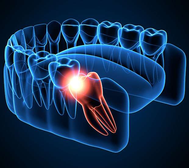 Hamilton Wisdom Teeth Extraction