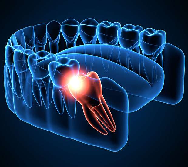 Hamilton Wisdom Teeth Extraction